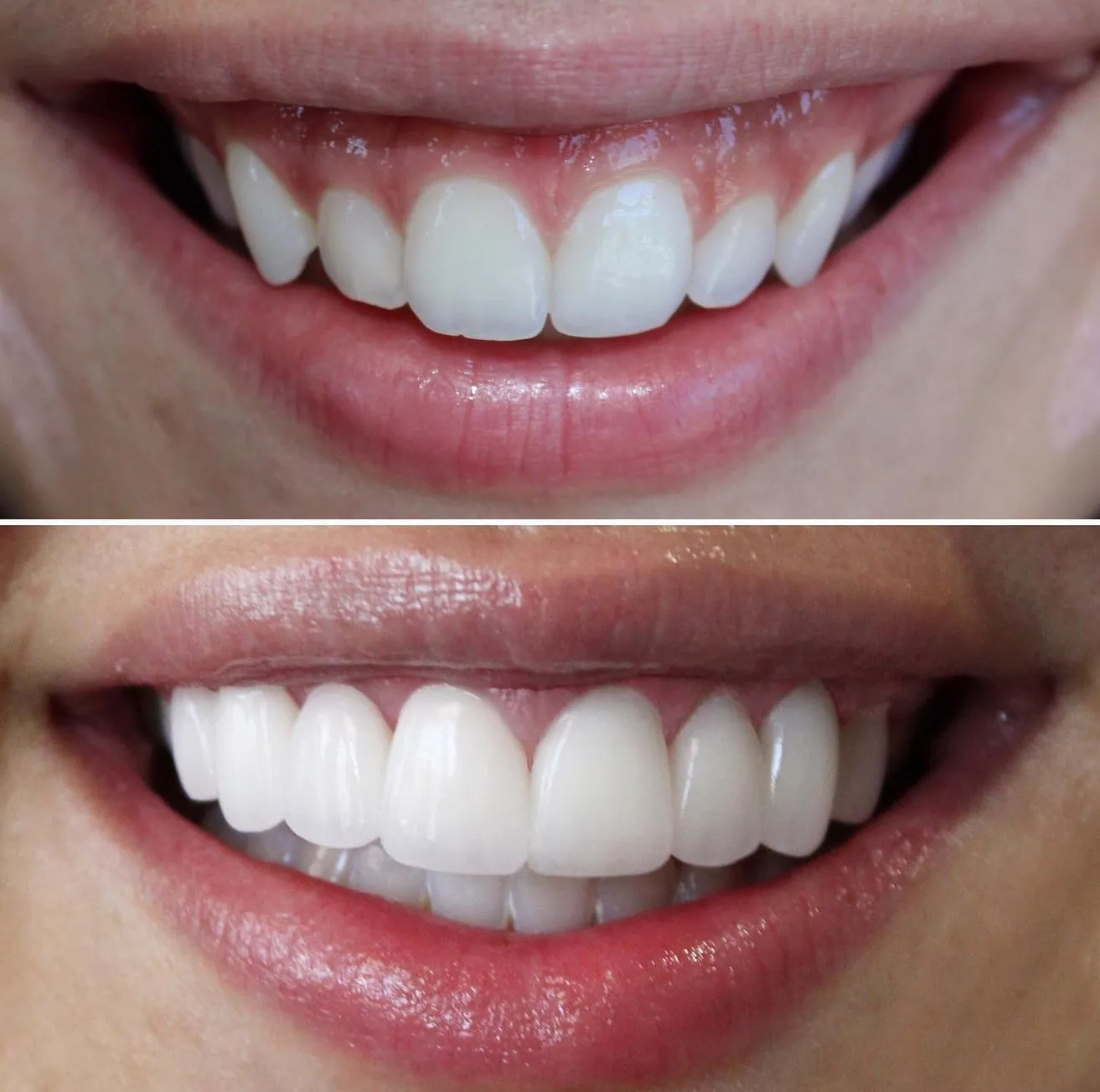 Vixens from Hell | Are Teeth Whitening Strips Dentist-Approved? Our Honest Recommendation