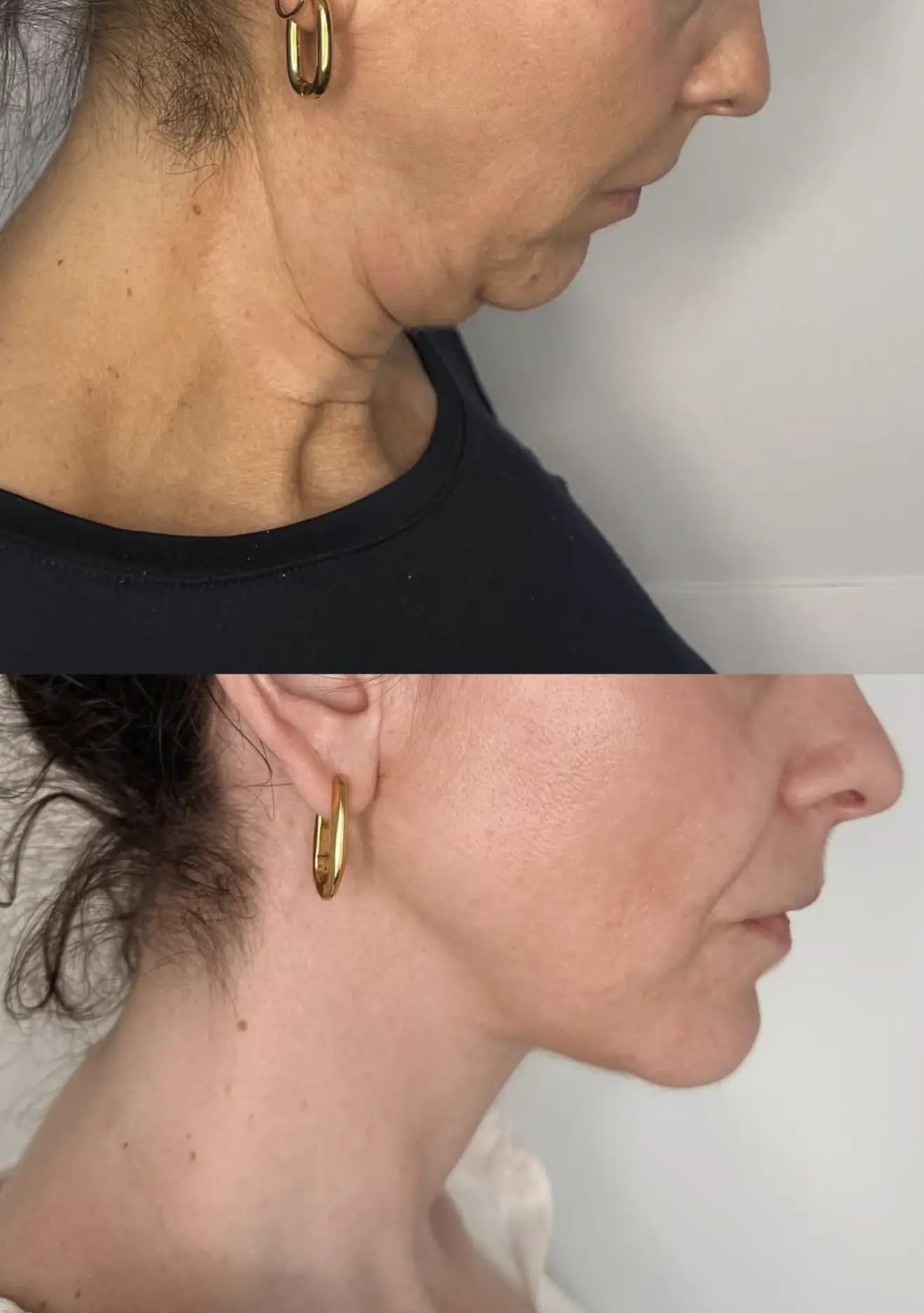 Vixens from Hell | Can Massage Actually Replace Dermal Fillers? does facial massage add volume to face