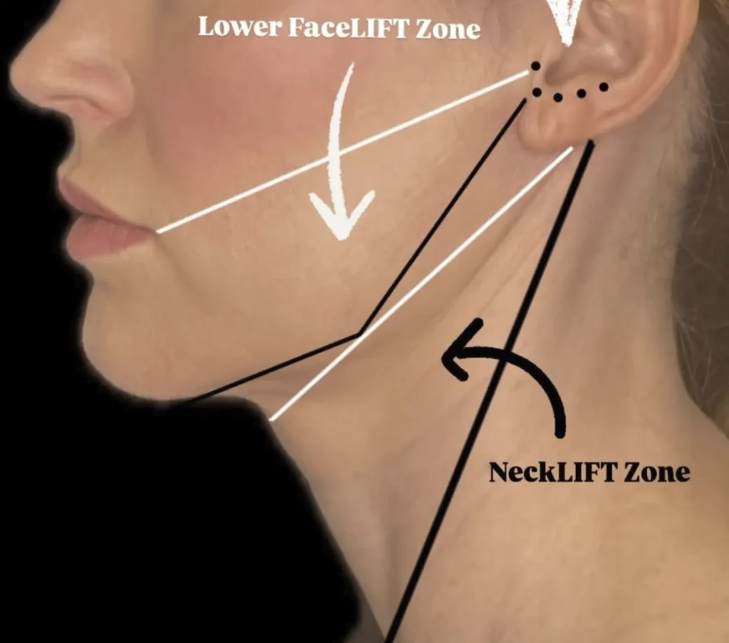 Can Massage Actually Replace Dermal Fillers?