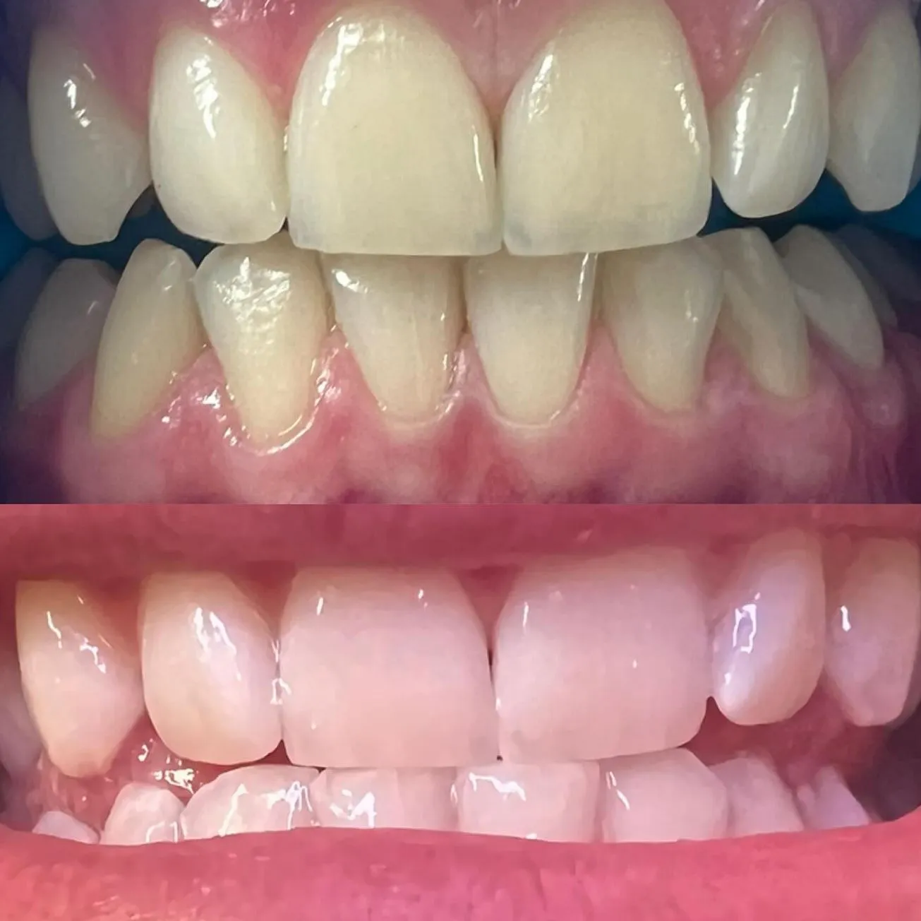 Vixens from Hell | Are Teeth Whitening Strips Dentist-Approved? teeth whitening